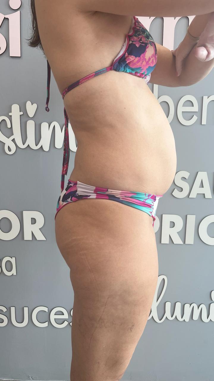 Antes - Diástase Abdominal