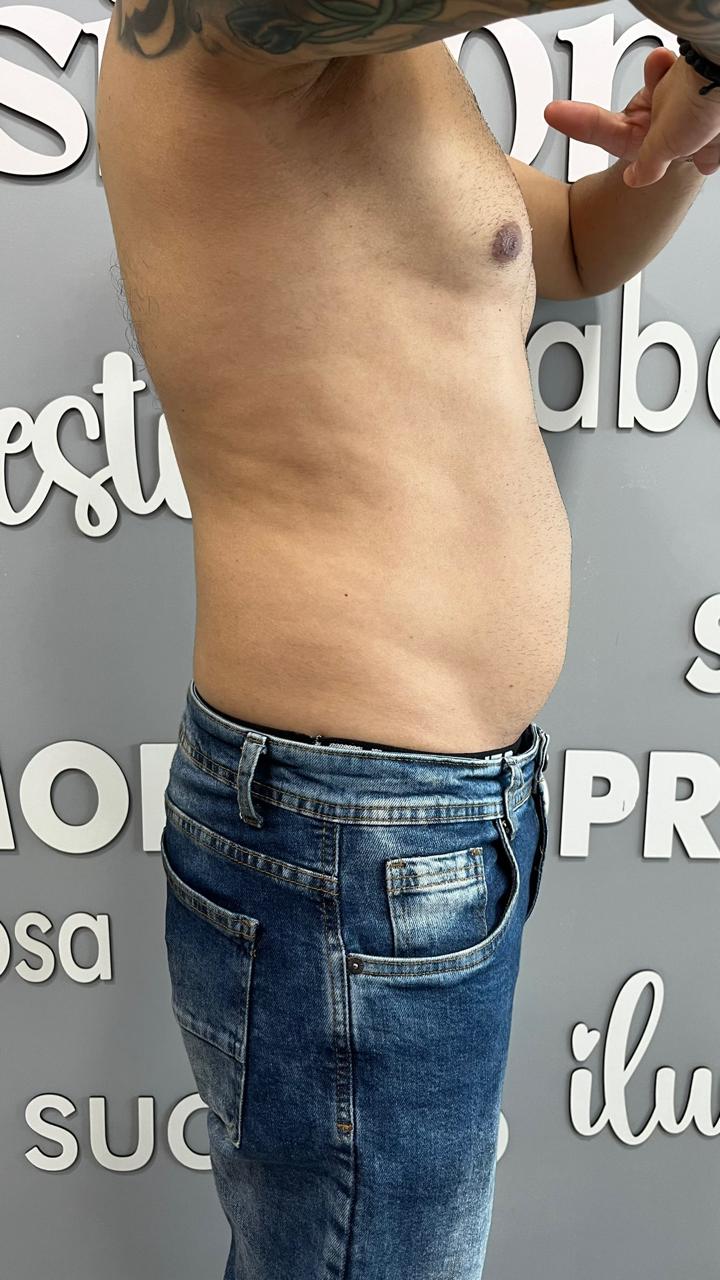 Antes - Protocolo personalizado