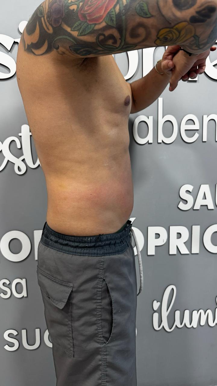 Depois - Protocolo personalizado